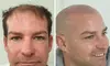 Scalp Micropigmentation Hair-Loss Treatment - Crown, Front, or Filler (Density Effect) - Women/Men(Up to 44%Off)