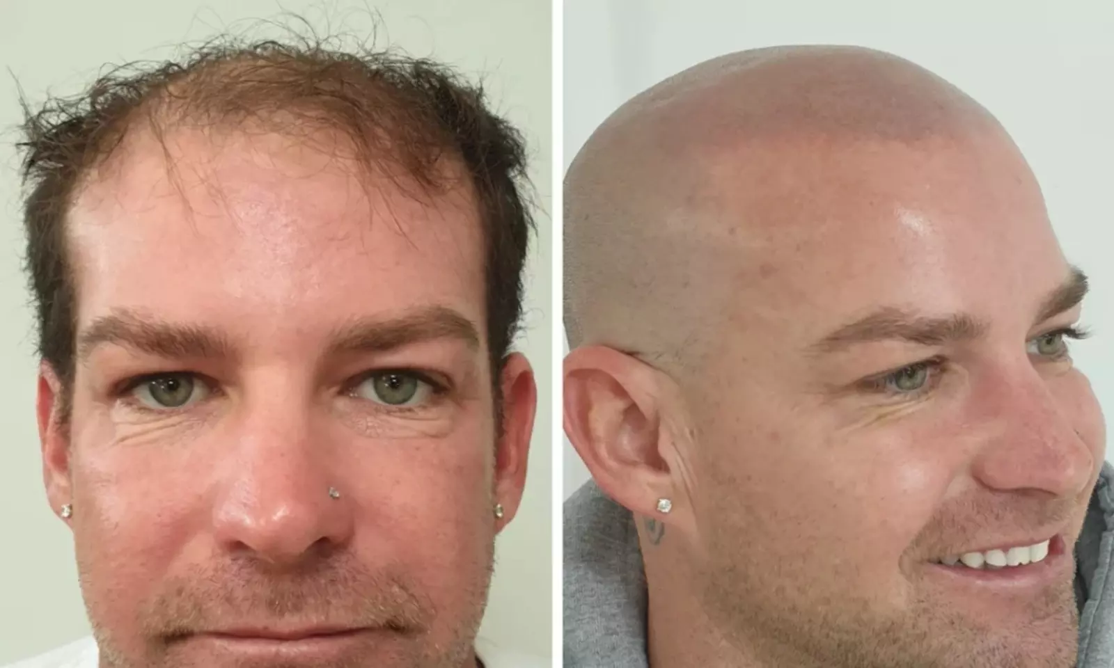 Scalp Micropigmentation Hair-Loss Treatment - Crown, Front, or Filler (Density Effect) - Women/Men(Up to 44%Off) - Primary Image