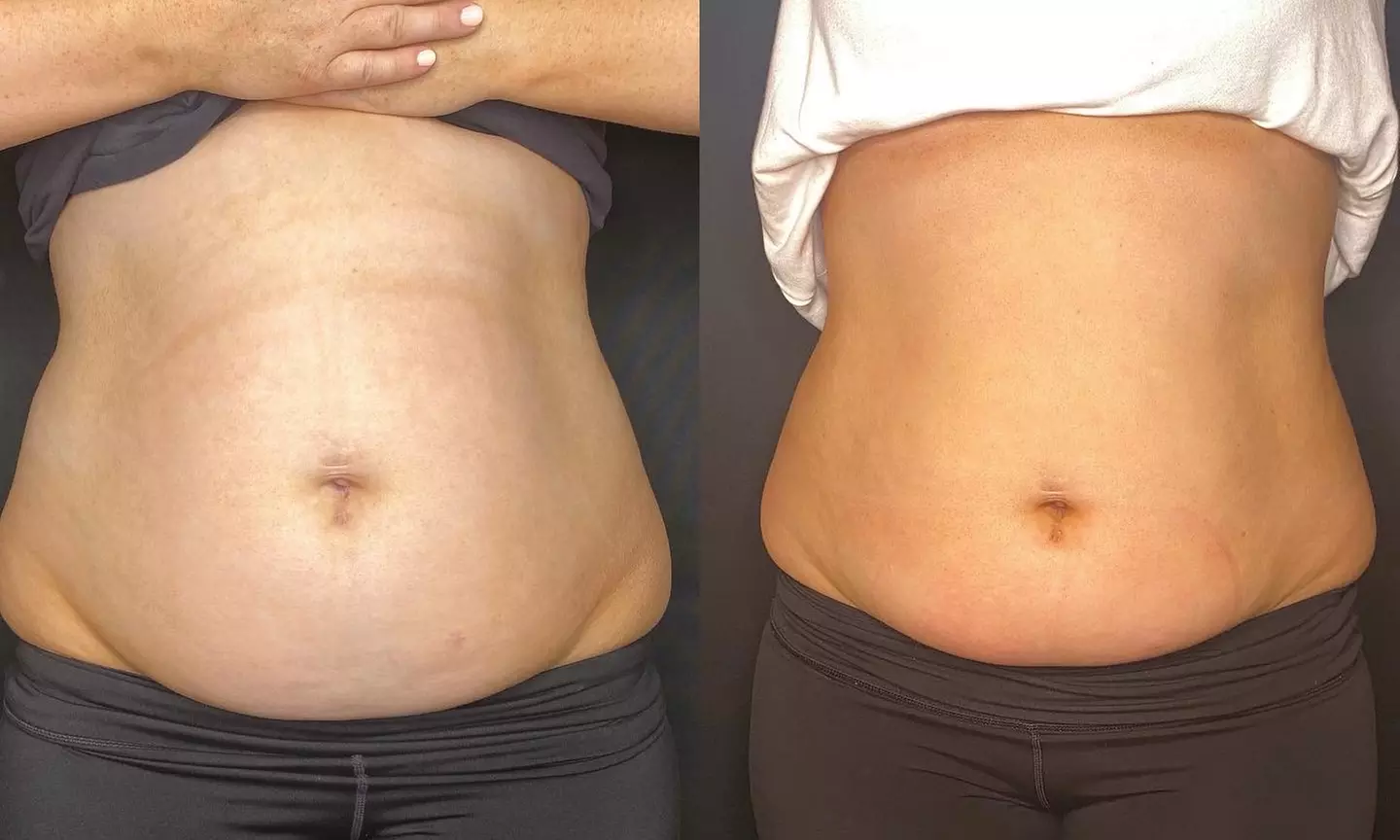 Up to 78% Off on Fat / Cellulite Reduction - Non-Branded at Curve Clinic