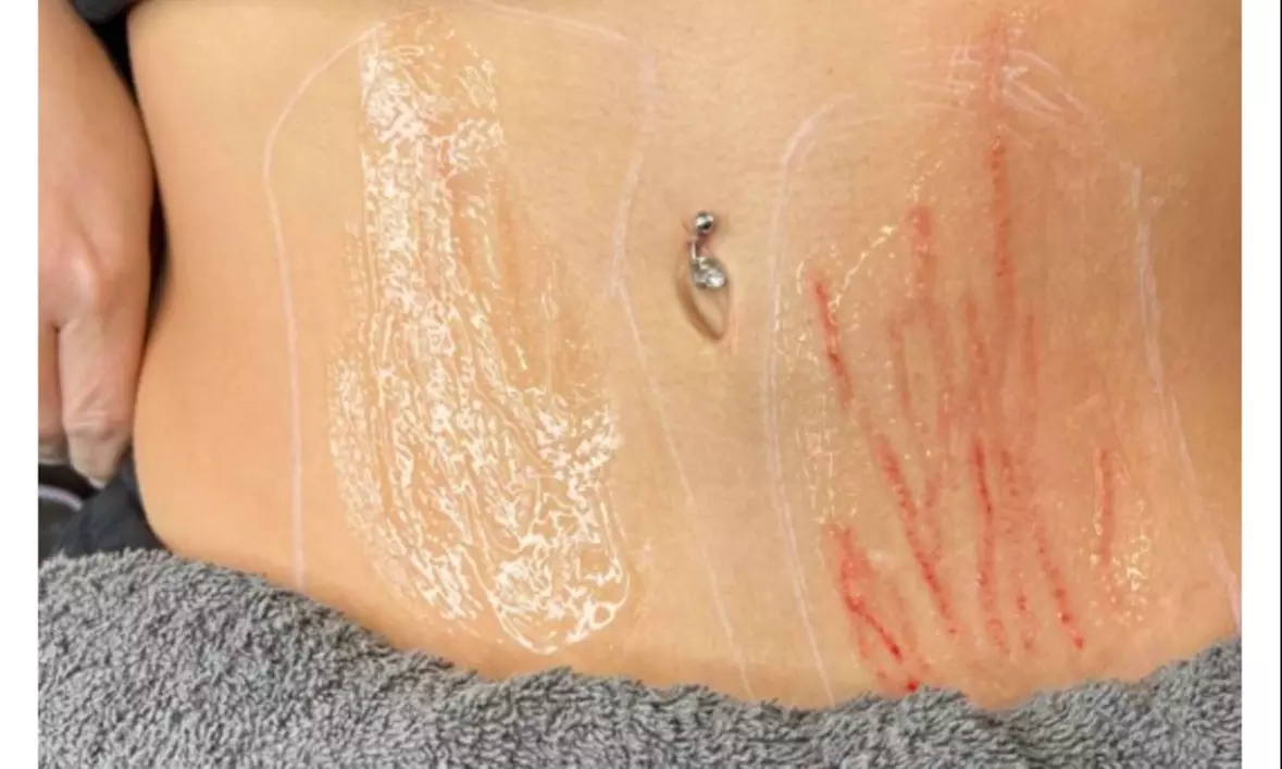 Up to 30% At Blink Body Sculpting, Get a Stretch Mark or Scar Camouflage Tattoo with Touch Up