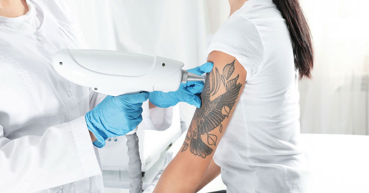 Sesiones de eliminación de tatuaje en Valencia