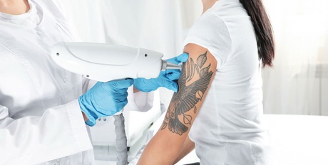 Eliminación de tatuaje: 6 sesiones / 5 x 5 cm