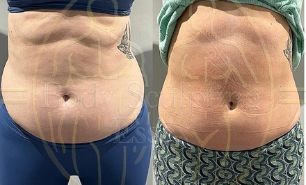60% OFF! 30 Minute ELectroMagnetic Body Sculpting, Muscle toning & Fat Reduction Treatment at Body Sculpting Essex - Body Sculpting Essex