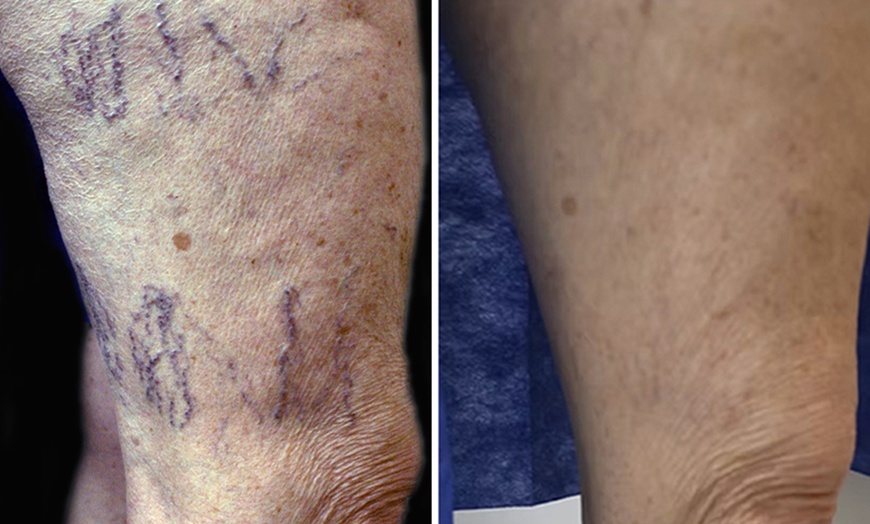 Image 1: Experience Radiant Legs with 15-Minute Sclerotherapy Treatment