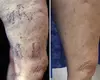 Discover Radiant Legs with Ageless Advanced Aesthetics' 15-Minute Sclerotherapy Treatment (Up to 63% Off)