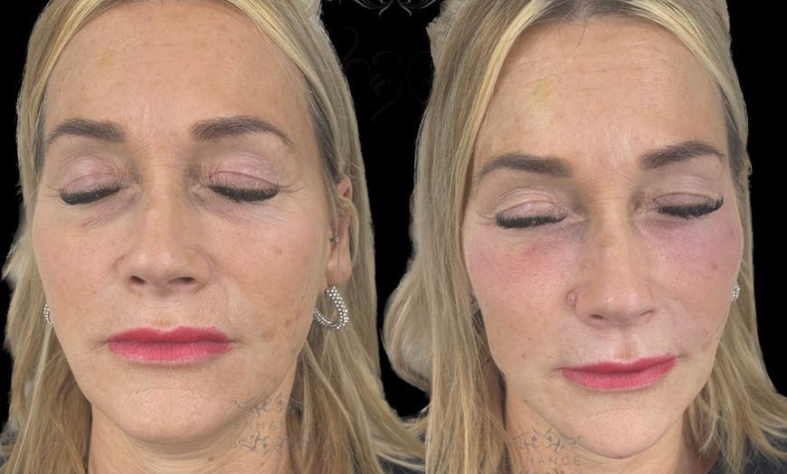 Image 1: Dermal Filler with Consultation at Shani Aesthetics