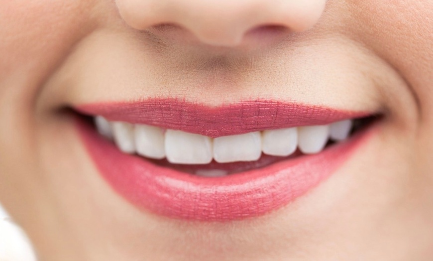 Image 1: 1 oder 2 Kosmetische Zahnbleachings à 30 Min. für 1 Person