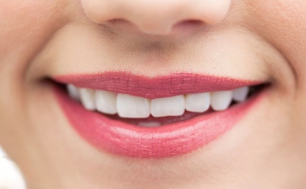 1 Kosmetisches Zahnbleaching à 30 Min. für 1 Person - Özgür Sarikaya Beauty