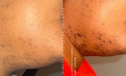 Three Laser Hair Removal Sessions on One Small Area (Touchup) - Element Aesthetic Laser Clinic
