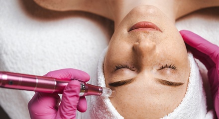 One Micro-Needling Treatment Session - Dermatone Skincare Studio