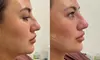 Enhance Your Nose Shape with Modern Aesthetics & Wellness's Liquid Rhinoplasty (Up to 30% Off) 