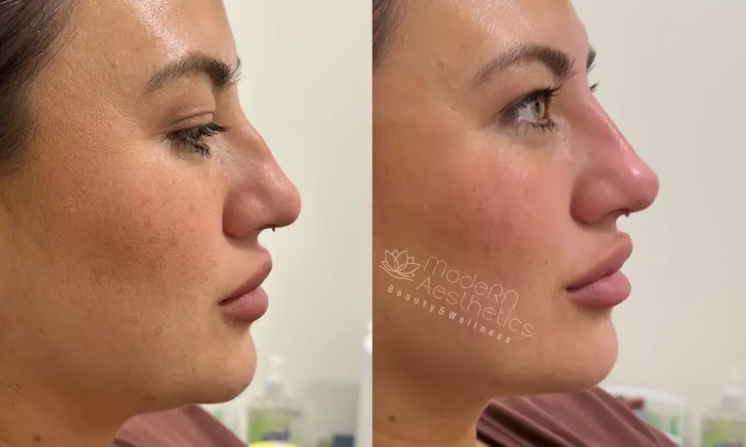 Enhance Your Nose Shape with Modern Aesthetics & Wellness's Liquid Rhinoplasty (Up to 30% Off)  - Primary Image