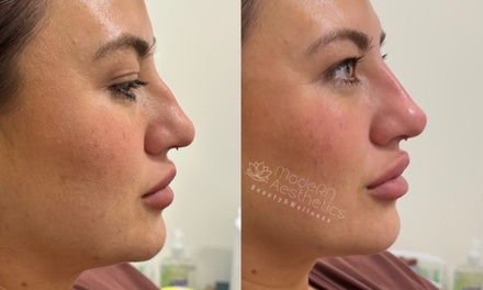 Liquid Rhinoplasty - Modern Aesthetics & Wellness