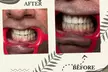 Up to 73% Off on Teeth Whitening at Aesthetics Care Med Spa - Second Medium