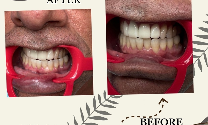 Image 3: Up to 76% Off on Teeth Whitening at Aesthetics Care Med Spa