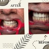 Image 3: Up to 76% Off on Teeth Whitening at Aesthetics Care Med Spa