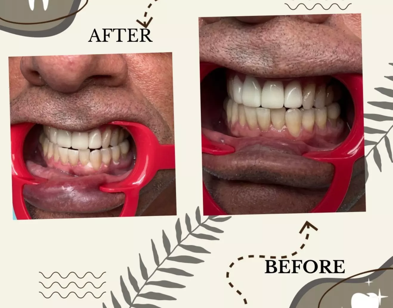 Up to 65% Off on Teeth Whitening at Aesthetics Care Med Spa