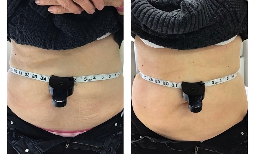 Image 5: Up to 60% Off on Cryolipolysis / Fat Freezing at Miso Life