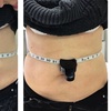 Image 5: Up to 60% Off on Cryolipolysis / Fat Freezing at Miso Life