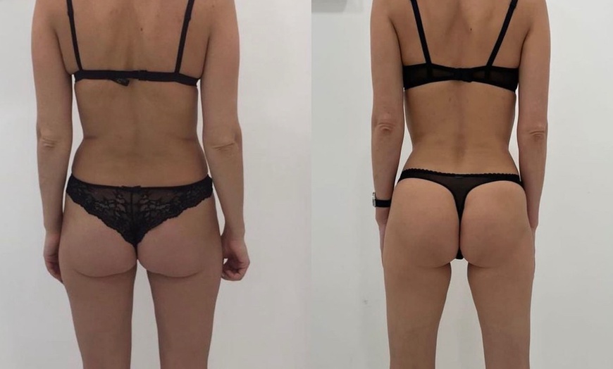 Image 6: Up to 55% Off on Endermologie at Love Your Body Endermologie  West Hollywood