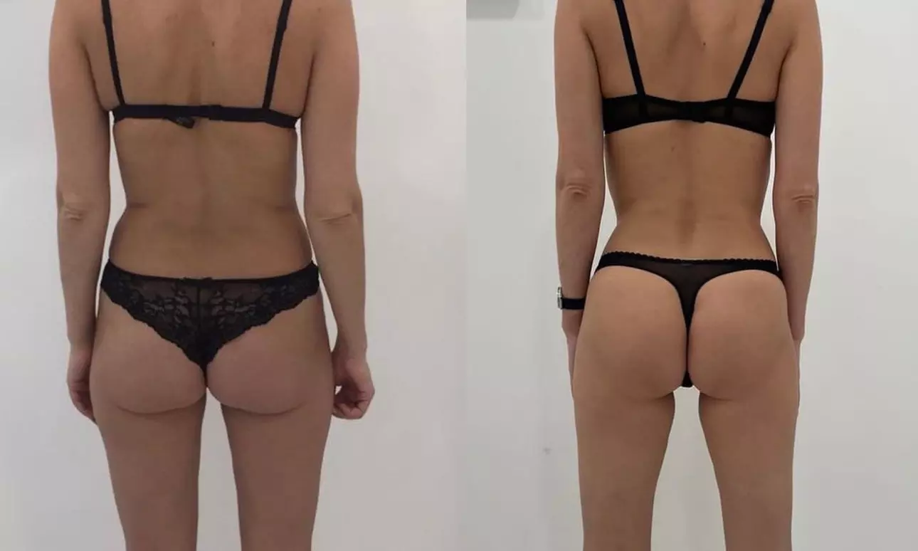 Up to 55% Off on Endermologie at Love Your Body Endermologie  West Hollywood