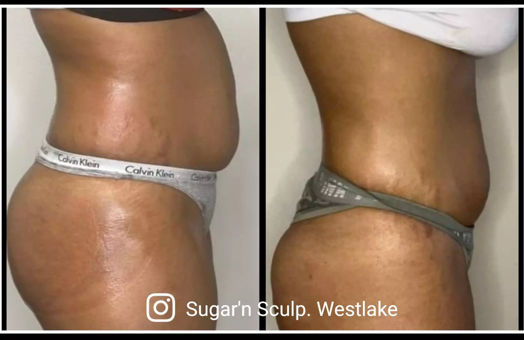 The Ultimate Body Sculpting Experience at Sugar'n Sculpt Westlake