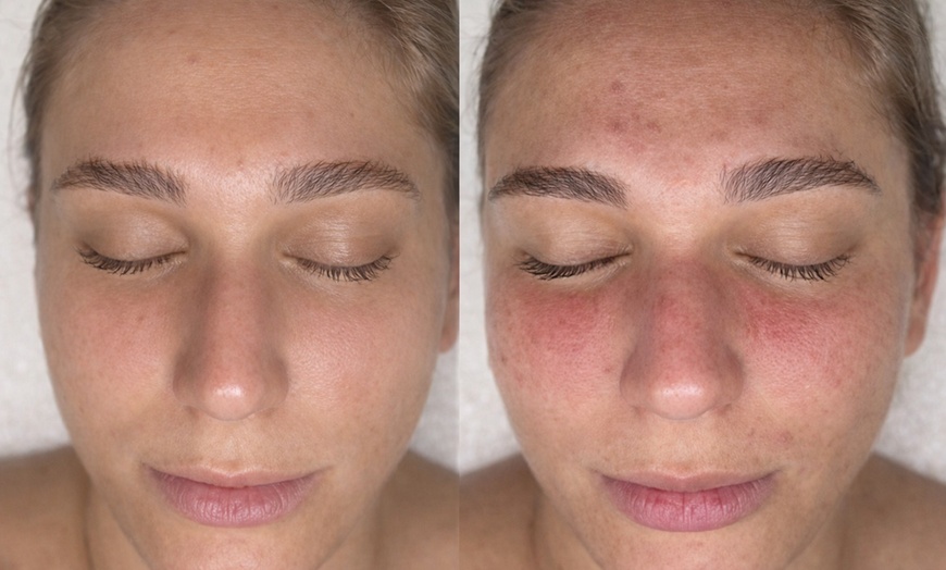 Image 2: Revitalize with One, Three, or Six Sessions of Micro-needling