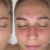 Image 2: Revitalize with One, Three, or Six Sessions of Micro-needling