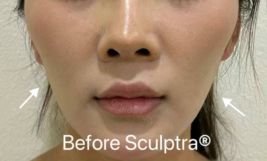 Image 2: 35% Off Sculptra or Radiesse at One Beauty Aesthetics