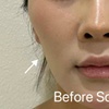 Image 2: 35% Off Sculptra or Radiesse at One Beauty Aesthetics