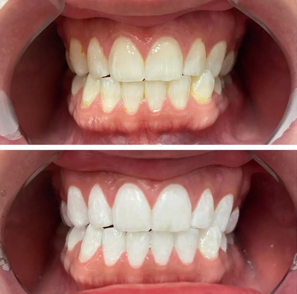 Brighten your smile with Browology's 25- and 45-minute teeth whitening sessions, up to 46% off - Primary Image