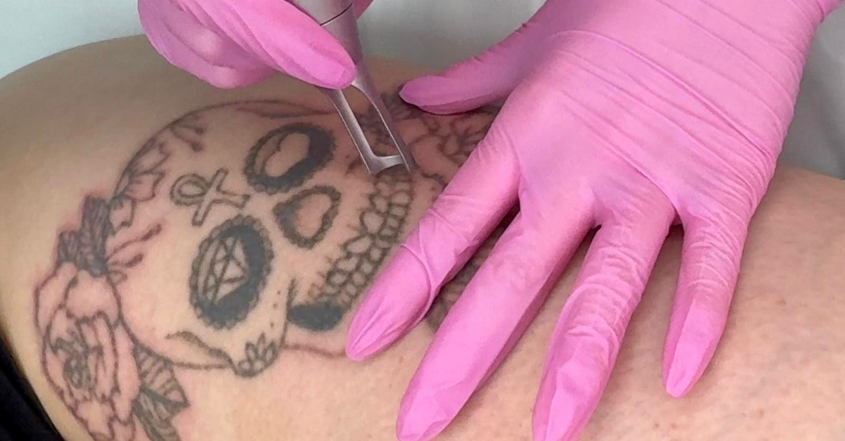 Up to 68% Off on Tattoo Removal at HL Lasers at Groupon