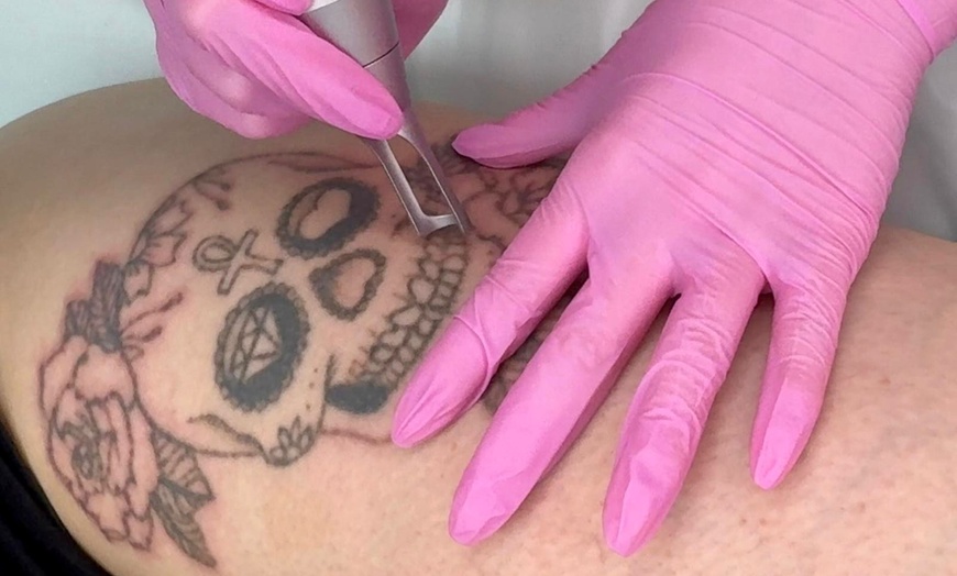 Image 1: Up to 68% Off on Tattoo Removal at HL Lasers