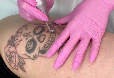 One Session: Tattoo Removal - Small Area - HL Lasers