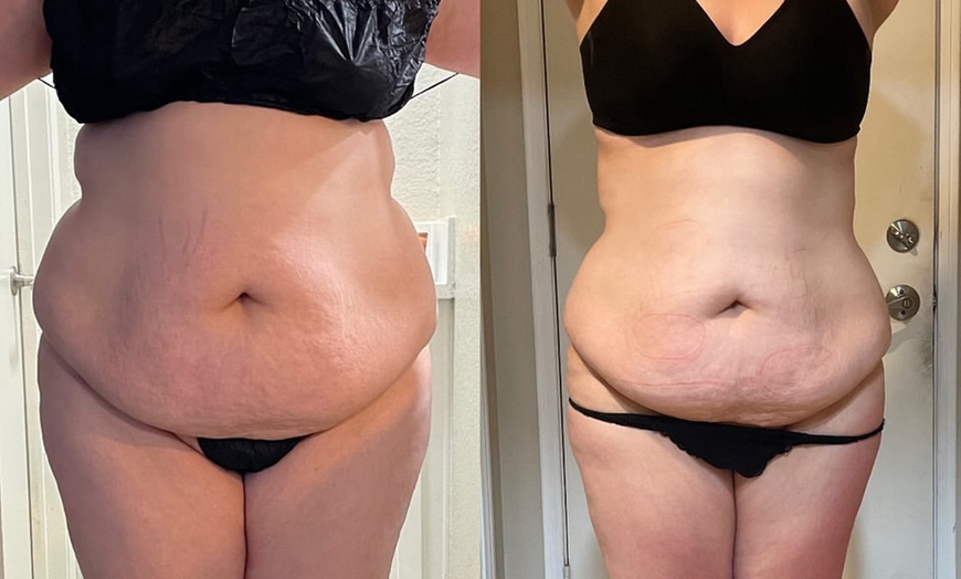Image 1: Up to 50% Off on Cavitation at Divine’s_Sculpting