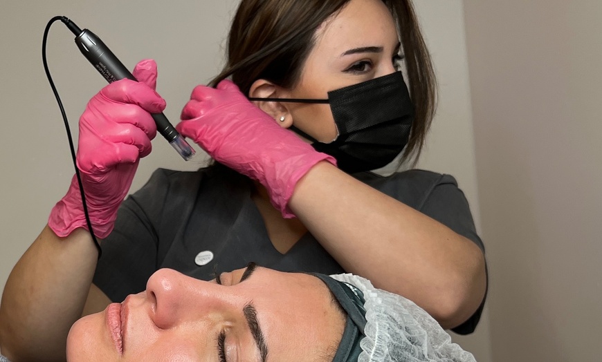 Image 2: 60 Min. Microneedling mit Serum nach Wahl, einlösbar für 1 Dame