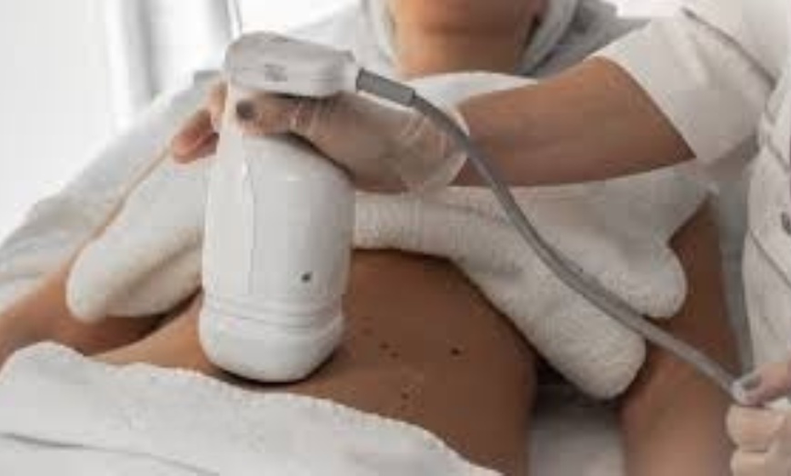 Image 4: Tratamiento HIFU facial o zona corporal con opción a radiofrecuencia