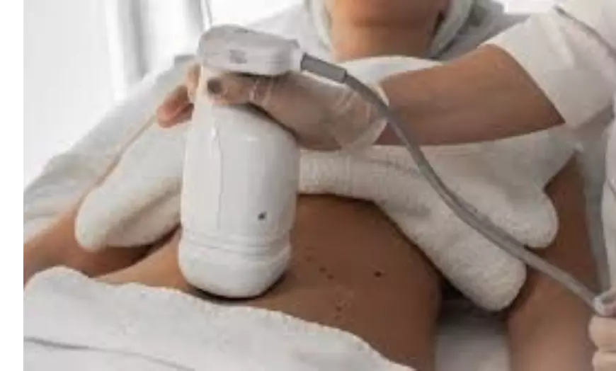 Image 4: Tratamiento HIFU facial o zona corporal con opción a radiofrecuencia