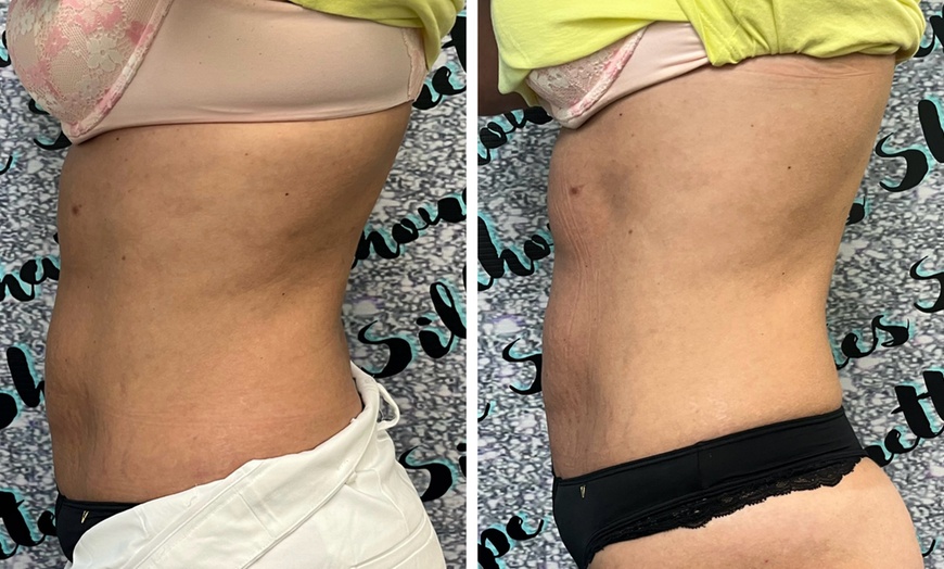 Image 3: Emsculpt Sessions: 30 or 60 Min for 2 or 4 Areas to Tone & Sculpt