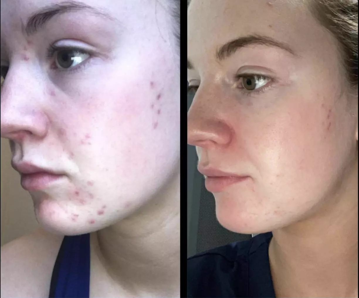 Say Goodbye to Acne: Plason Plasma Clear Acne Treatment Plan