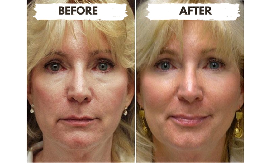 Image 5: 1/2, 1, 2, or 4 Vials of Sculptra Collagen-Stimulating Injectables