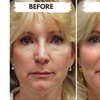 Image 5: 1/2, 1, 2, or 4 Vials of Sculptra Collagen-Stimulating Injectables