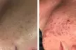 Revitalize with One or Three Teen/Adult Acne Laser Skin Resurfacing Sessions at D. R. Laser LLC (Up to 52%
Off) - Second Medium