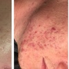 Image 3: Refresh Your Skin w/ 1 or 3 Teen Acne Laser Skin Resurfacing Sessions 