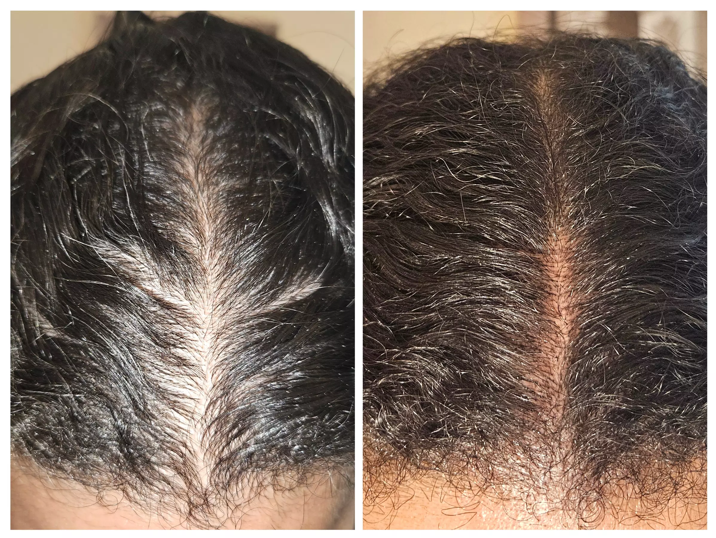 Up to 50% Off on Men and Women's Scalp Micropigmentation