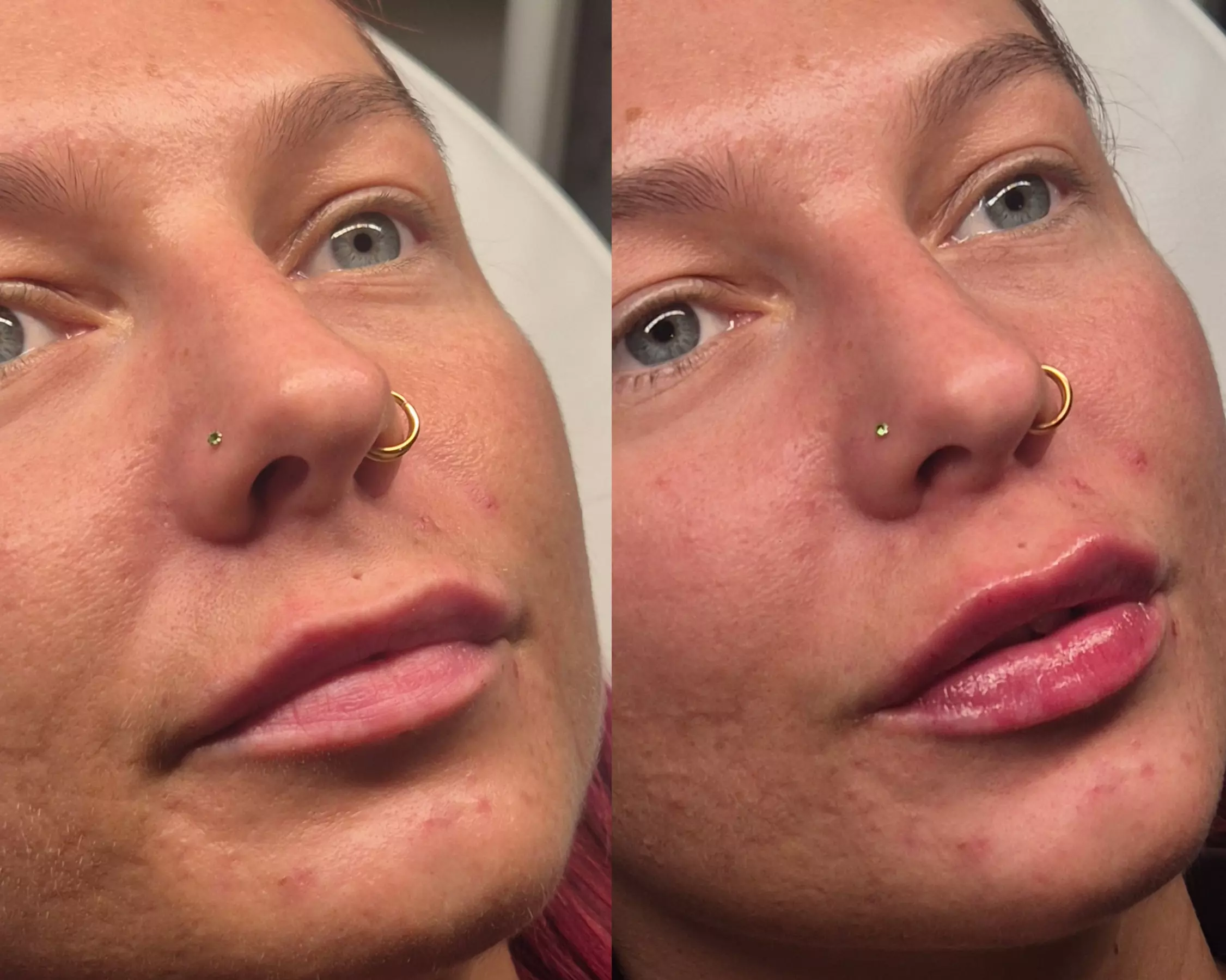 Dermal Filler Treatments to Enhance & Define Facial Features