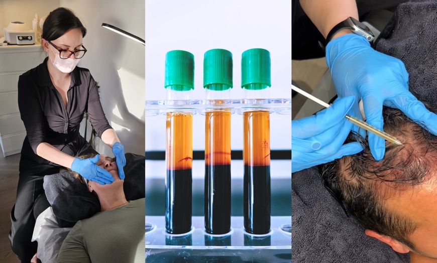 Image 4: Transform Your Hair with One or Three PRP Hair Restoration Sessions