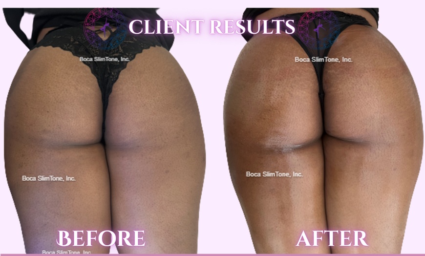 Image 4: Discover Non-Surgical BumBum Butt Lift Sessions