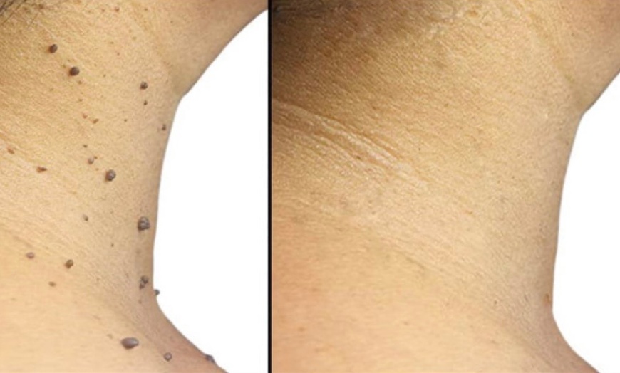 Image 4: Removal of 1, 2, or 3 Skin Tags, Angiomas, Milia, or Age Spots