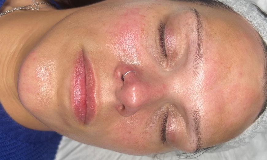 Image 8: Up to 59% Off on Facial - HydraFacial at RefreshSkinTherapy